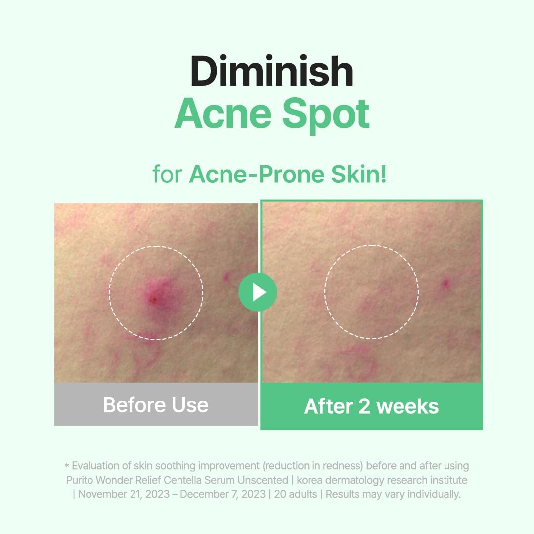 PURITO SEOUL Wonder Releaf Centella Serum Unscented bottle for soothing redness and skin barrier repair. Diminish acne spot