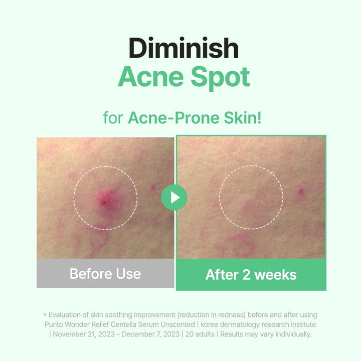 PURITO SEOUL Wonder Releaf Centella Serum Unscented bottle for soothing redness and skin barrier repair. Diminish acne spot